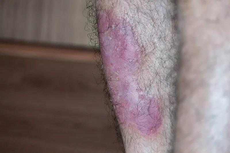 間充質(zhì)干細(xì)胞成功治療斑塊狀銀屑?。喊咐芯? class=