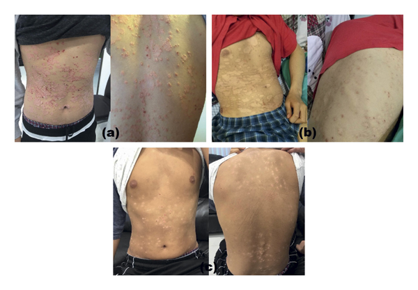 G-MSC輸注對一名有5年嚴(yán)重斑塊狀銀屑病病史的19歲男性的影響。