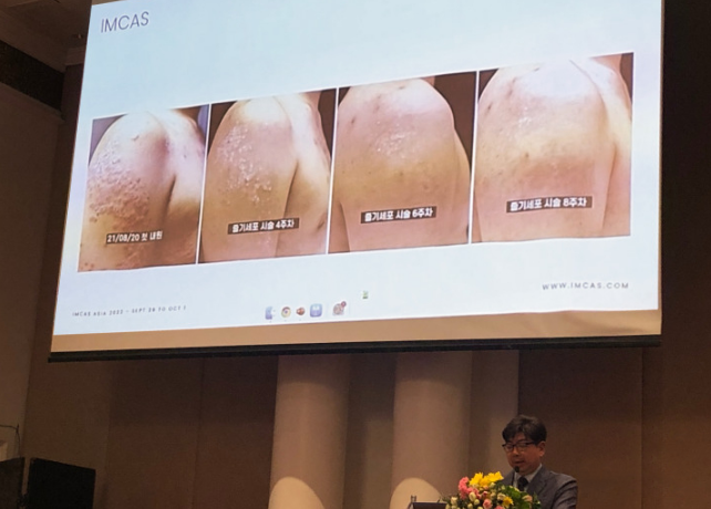 韓國(guó)Miracell在國(guó)際美容整形外科宣布用干細(xì)胞療法治愈銀屑病 韓國(guó)Miracell在國(guó)際美容整形外科宣布用干細(xì)胞療法治愈銀屑病