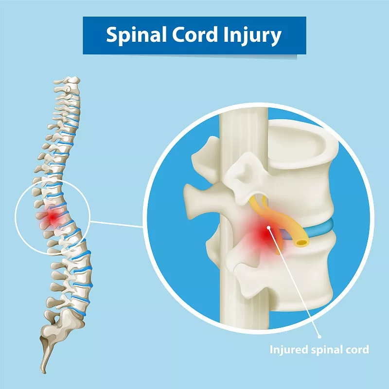 神經(jīng)干/祖細(xì)胞移植治療慢性脊髓損傷的臨床研究進(jìn)展 神經(jīng)干/祖細(xì)胞移植治療慢性脊髓損傷的臨床研究進(jìn)展