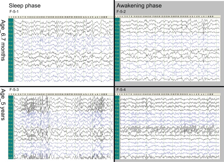 圖5：腦電圖。