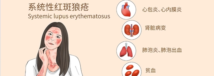 系統(tǒng)性紅斑狼瘡