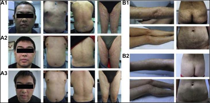 間充質(zhì)干細胞治療銀屑病的臨床案例 間充質(zhì)干細胞治療銀屑病的臨床案例