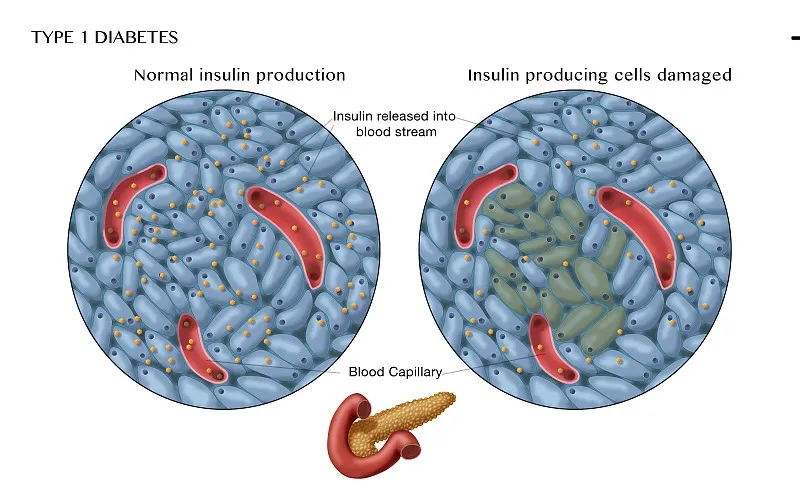 間充質(zhì)干細(xì)胞在1型糖尿病治療中的作用 間充質(zhì)干細(xì)胞在1型糖尿病治療中的作用