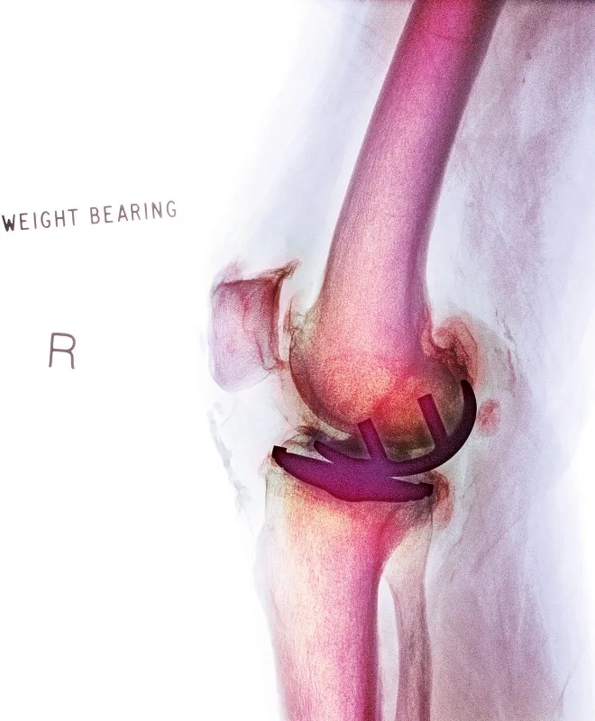 關節(jié)內移植干細胞治療膝骨關節(jié)炎:一項IIb期臨床試驗