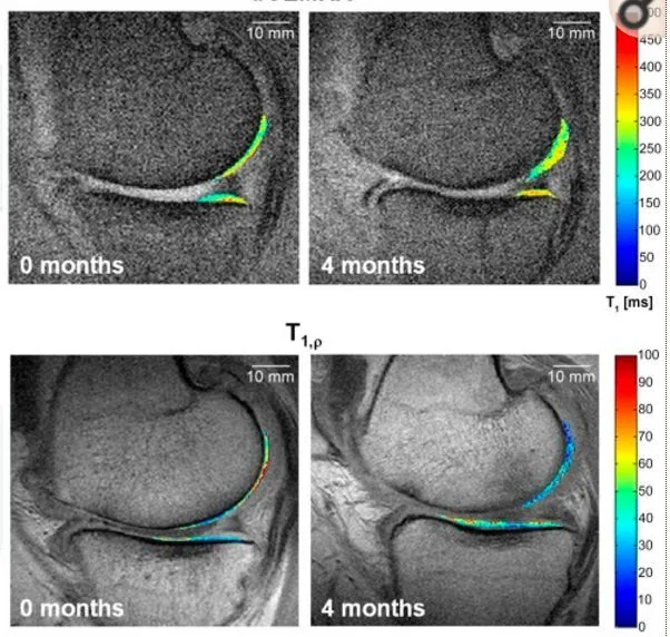 干細胞療法修復(fù)后疼痛顯著減輕，半月板軟骨質(zhì)量提高。