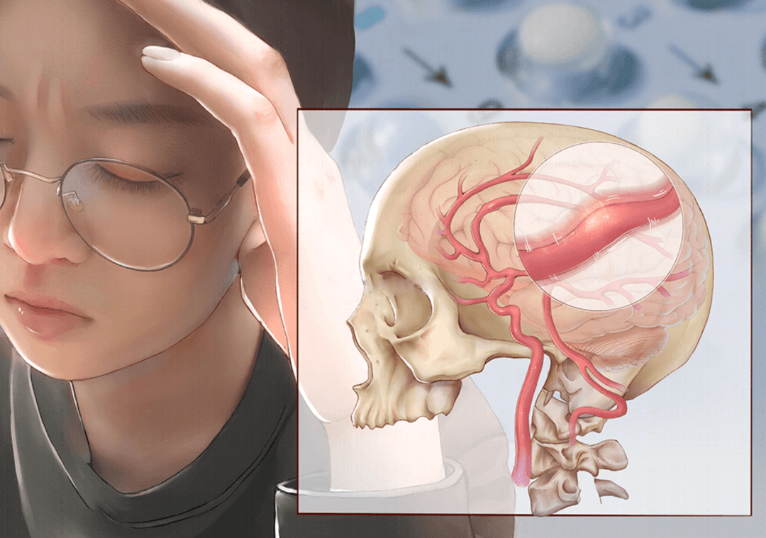 什么是偏頭痛？