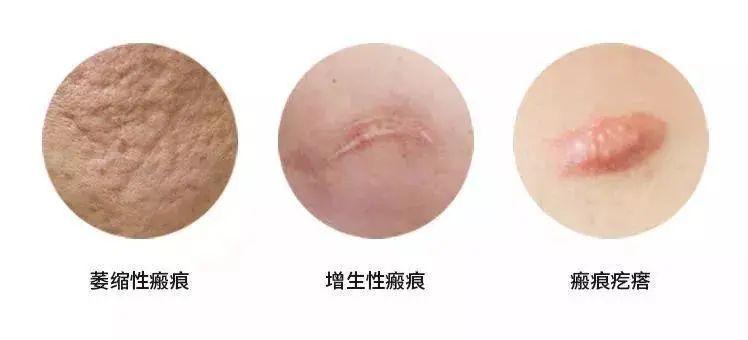 根據(jù)瘢痕的顏色、質(zhì)地和形態(tài)，臨床可以將瘢痕分為三大類：萎縮性瘢痕、增生性瘢痕和瘢痕疙瘩。