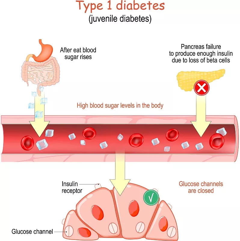 1型糖尿病癥狀有哪些？