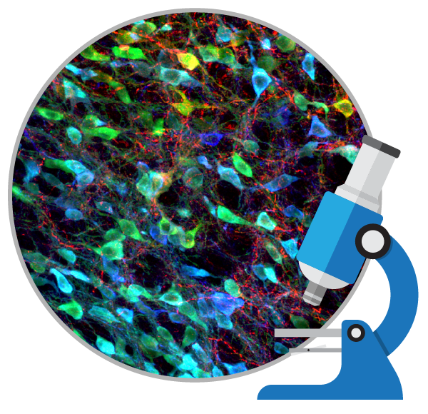 盤點(diǎn):干細(xì)胞移植治療帕金森病的臨床研究進(jìn)展