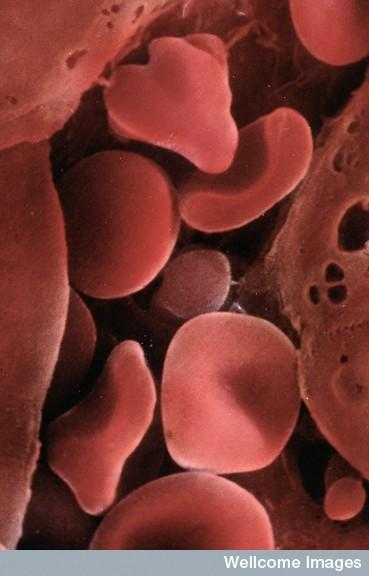 許多血液疾病已經(jīng)可以使用臍帶血進行治療。