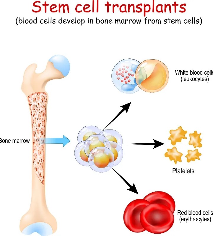 干細(xì)胞移植手術(shù) 干細(xì)胞移植手術(shù)