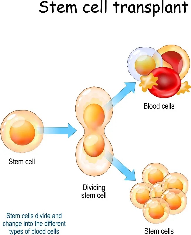 干細(xì)胞移植的五個階段是什么 干細(xì)胞移植的流程分為那五個階段
