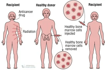 什么是造血干細(xì)胞和造血干細(xì)胞移植 什么是造血干細(xì)胞和造血干細(xì)胞移植