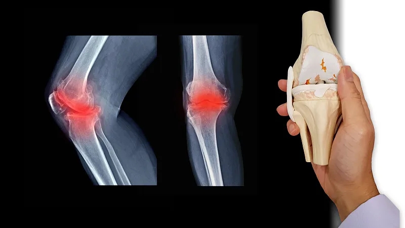 什么是骨關(guān)節(jié)炎-骨關(guān)節(jié)炎癥狀有哪些 什么是骨關(guān)節(jié)炎-骨關(guān)節(jié)炎癥狀有哪些