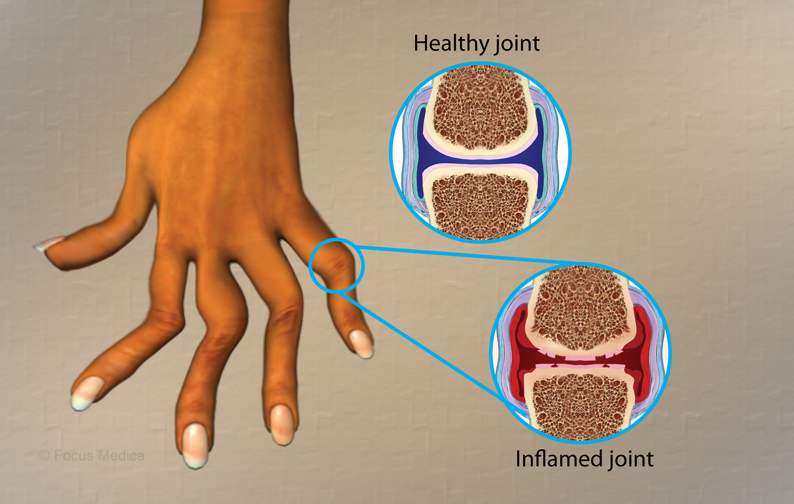 類風(fēng)濕關(guān)節(jié)炎是什么病 類風(fēng)濕關(guān)節(jié)炎是什么病