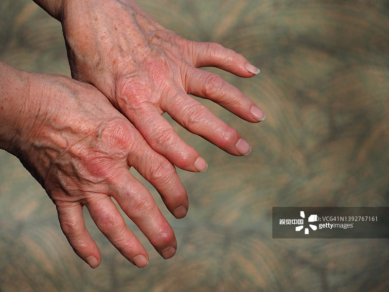 研究為治療類風(fēng)濕性關(guān)節(jié)炎開辟了新的治療途徑 研究為治療類風(fēng)濕性關(guān)節(jié)炎開辟了新的治療途徑