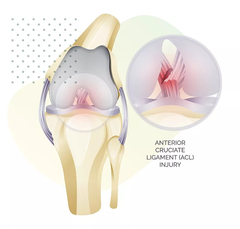 干細(xì)胞療法對半月板損傷的益處 干細(xì)胞療法對半月板損傷的益處