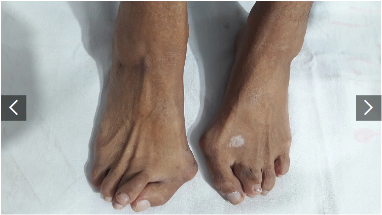 類(lèi)風(fēng)濕關(guān)節(jié)炎癥狀