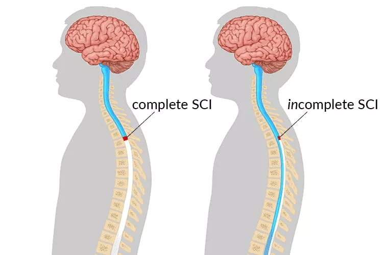 不完整和完整的脊髓損傷有什么區(qū)別 不完整和完整的脊髓損傷有什么區(qū)別
