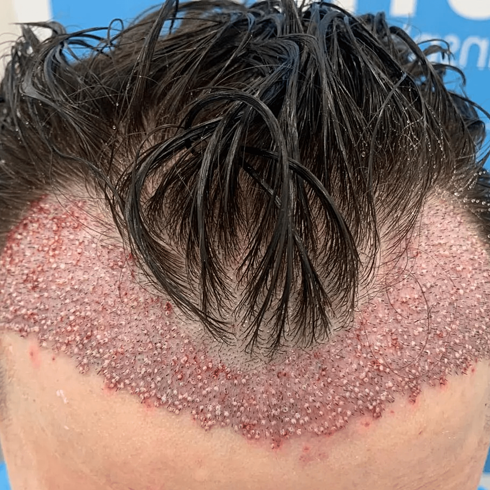 頭發(fā)移植手術(shù)后即刻的結(jié)果。——這允許在患者中建立更豐滿(mǎn)和更前的發(fā)際線(xiàn)