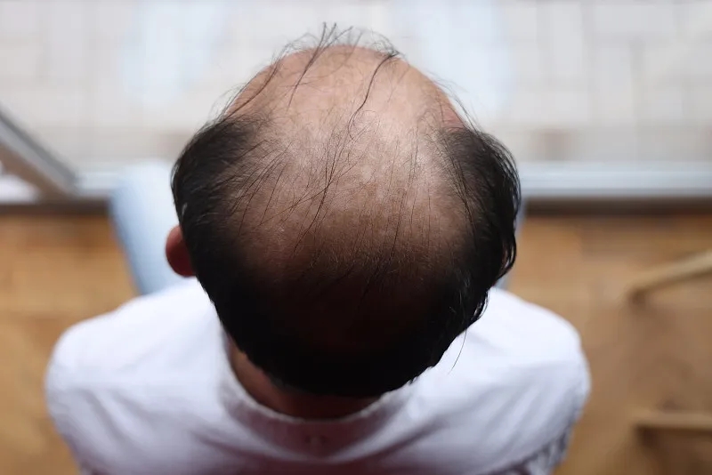 干細(xì)胞治療脫發(fā)的優(yōu)缺點 干細(xì)胞治療脫發(fā)的優(yōu)缺點