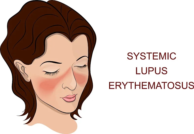 系統(tǒng)性紅斑狼瘡是一種自身免疫性疾病，其特征在于針對(duì)細(xì)胞核和細(xì)胞質(zhì)抗原的自身抗體