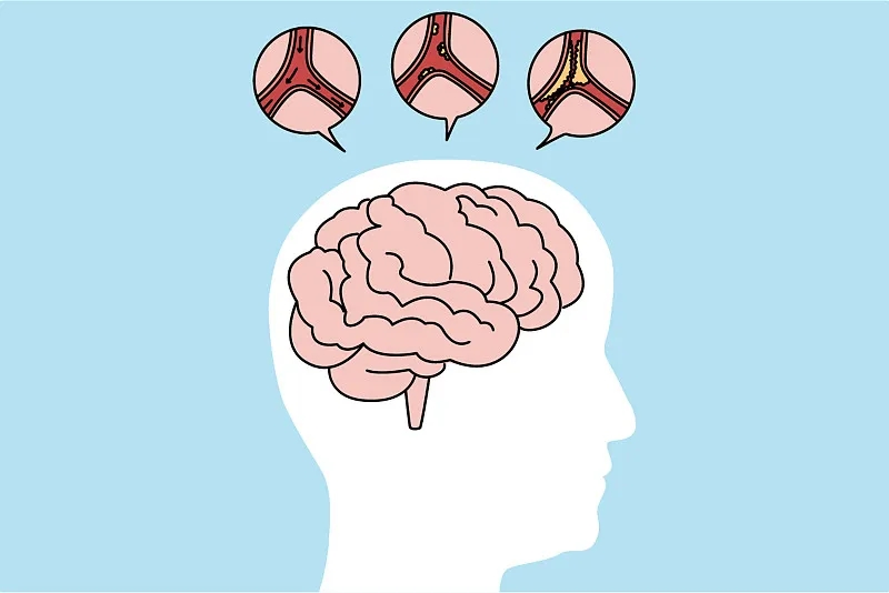 通過比較6、12、24個月的結(jié)果，來評估干細胞治療缺血性中風(fēng)的有效性和安全性