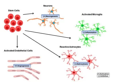 干細胞治療中風的結(jié)果 干細胞治療中風的結(jié)果