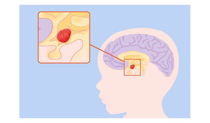 干細胞治療腦癱的成功率是多少？