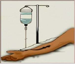 靜脈注射圖像。