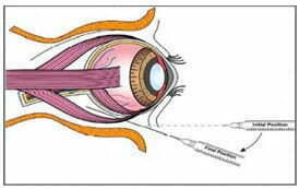 6. 細胞后小管輸注
