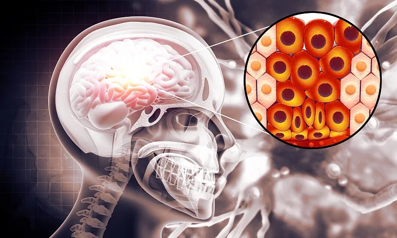 羊膜細胞療法治療缺血性中風患者的I期試驗結(jié)果 羊膜細胞療法治療缺血性中風患者的I期試驗結(jié)果