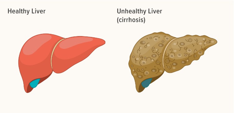 導(dǎo)致肝臟疾病的問題及其原因 導(dǎo)致肝臟疾病的問題及其原因