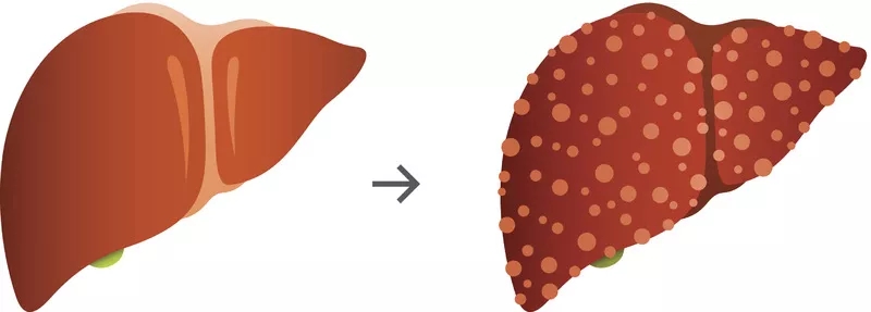 肝硬化的體征和癥狀是什么？及其治療方法
