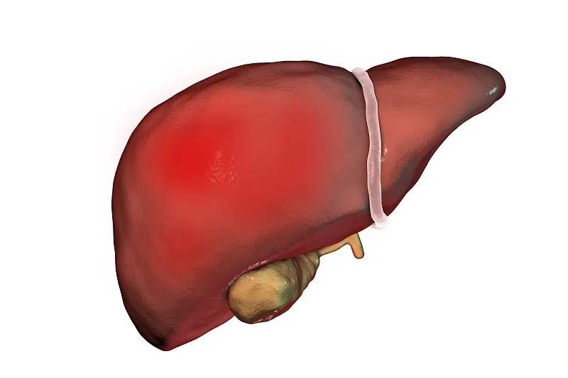 什么是丁型肝炎？