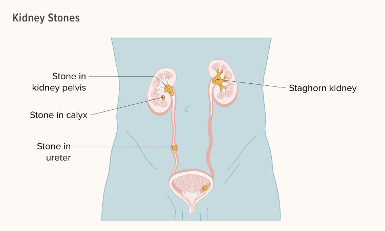 關(guān)于腎結(jié)石您需要知道的一切 關(guān)于腎結(jié)石您需要知道的一切