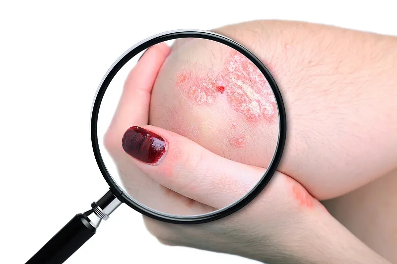 國內(nèi)已有7項(xiàng)臨床研究項(xiàng)目，干細(xì)胞治療銀屑病，未來可期！