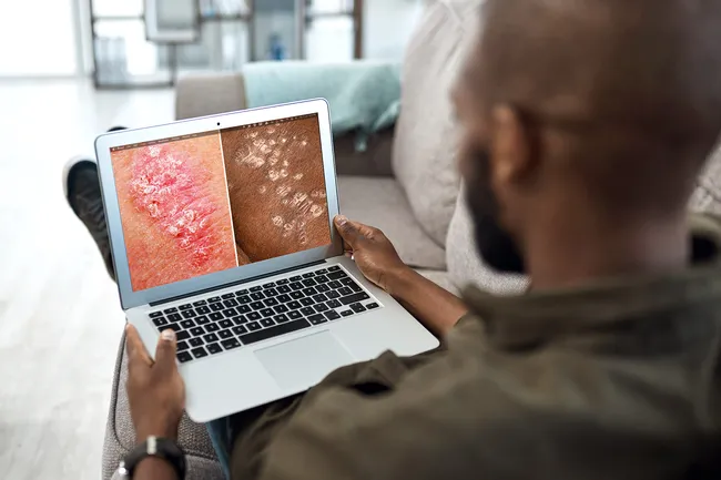 銀屑病的癥狀、類型和原因