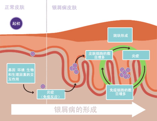 銀屑病治愈：是科學(xué)事實(shí)還是虛假希望？