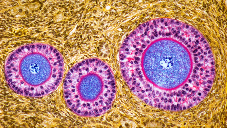卵巢早衰體征和癥狀是什么？及其治療方法