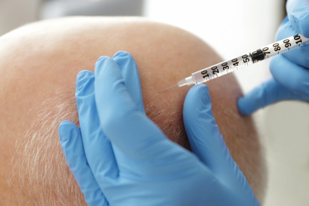 頭發(fā)修復(fù)過程是怎樣的？ |  干細(xì)胞治療脫發(fā)