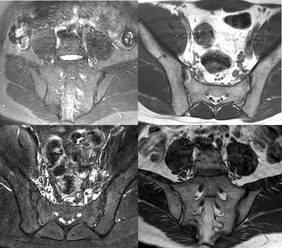 強(qiáng)直性脊柱炎是遺傳病嗎？