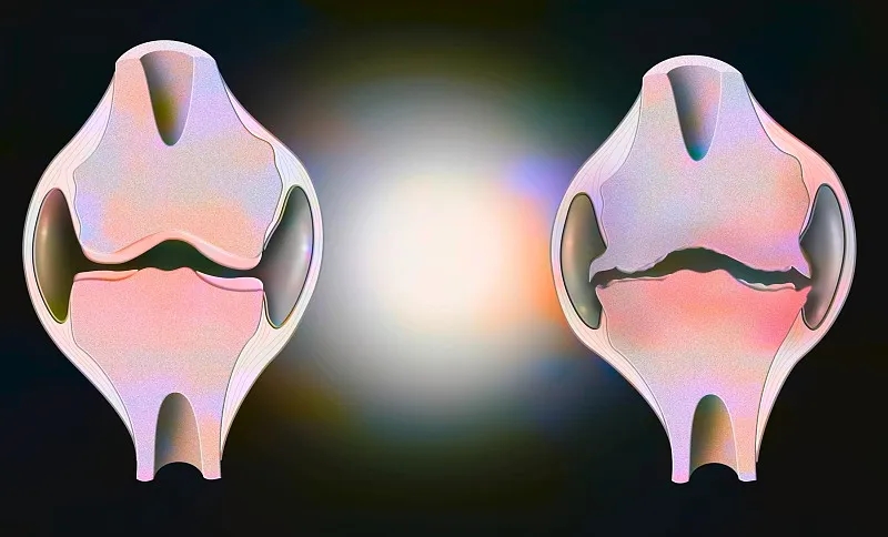 盤(pán)點(diǎn):2020~2023年干細(xì)胞治療骨關(guān)節(jié)炎的臨床研究進(jìn)展 盤(pán)點(diǎn):2020~2023年干細(xì)胞治療骨關(guān)節(jié)炎的臨床研究進(jìn)展