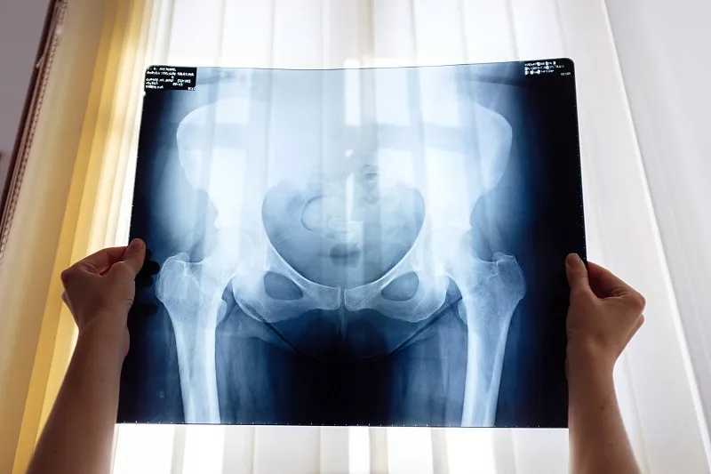 干細(xì)胞治療股骨頭缺血性壞死的臨床療效研究 干細(xì)胞治療股骨頭缺血性壞死的臨床療效研究