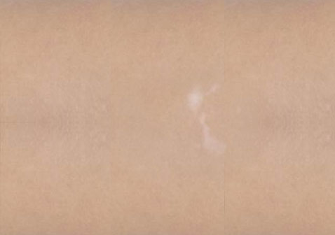 白癜風白斑初期癥狀輕微小斑點，無色素。