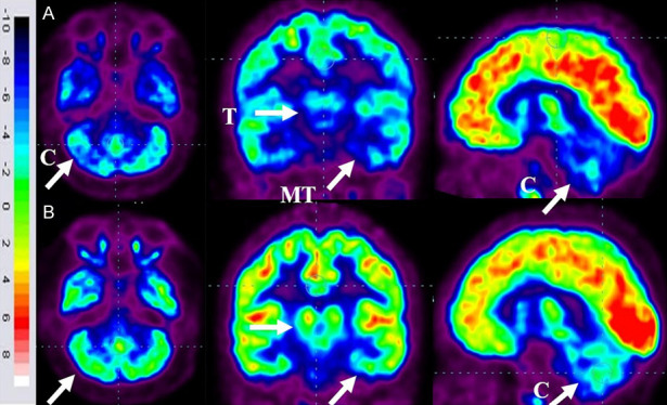 圖6：ASD患者在細(xì)胞治療前和細(xì)胞治療后6個月進(jìn)行的FDG-PET/CT大腦掃描的代表性圖像。