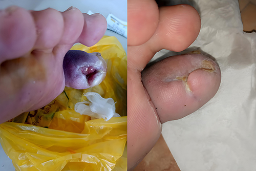 圖4：糖尿病潰瘍修復(fù)示例–干預(yù)前（左）和干預(yù)后（右）。