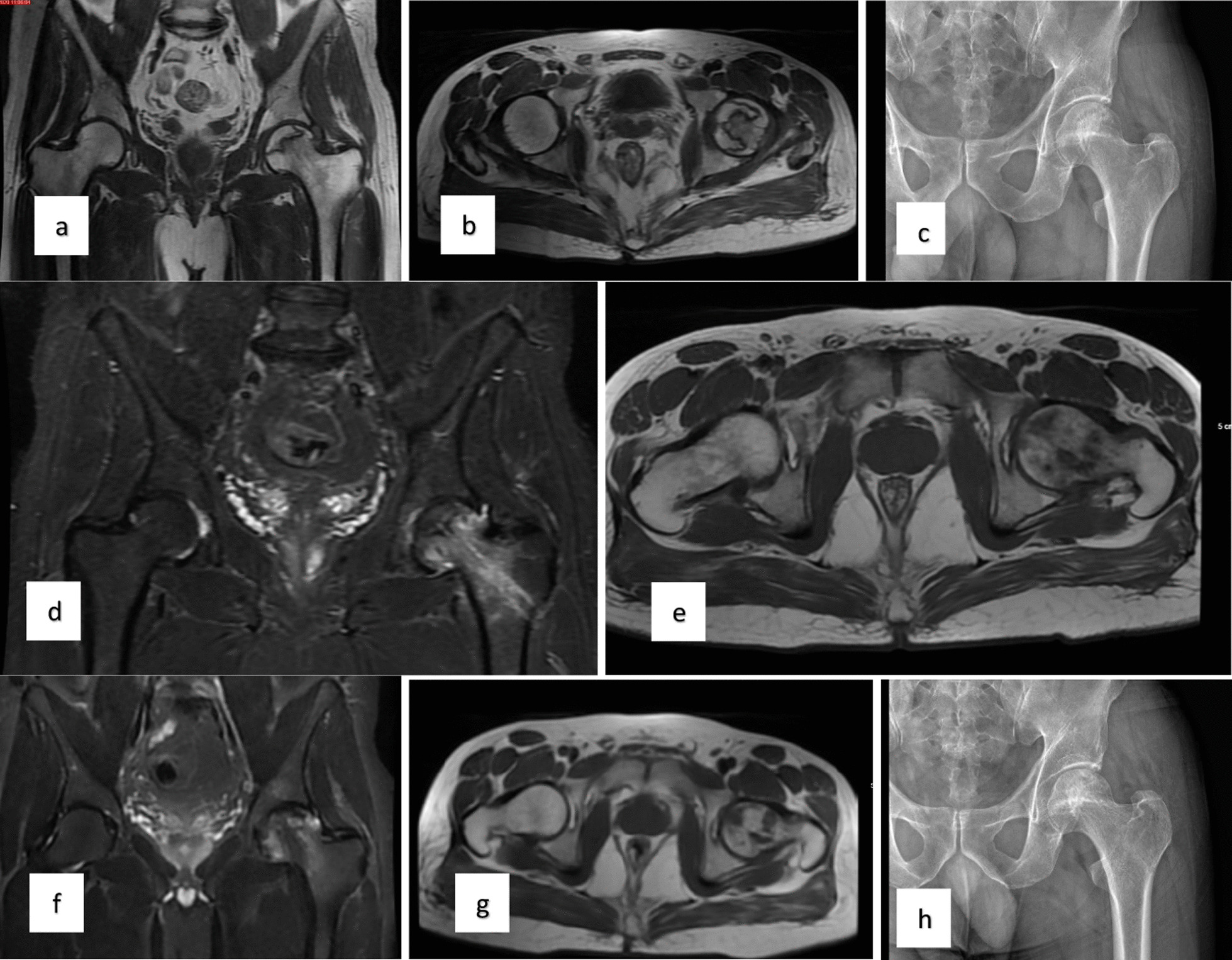 對患者的術(shù)前、3個(gè)月、6個(gè)月、1年和2年隨訪進(jìn)行評估（圖1）。
