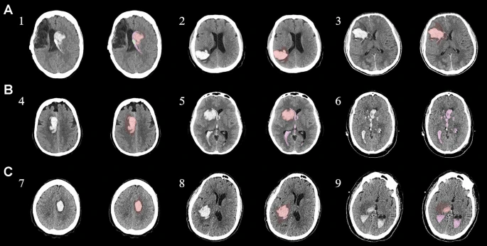 圖1：每個間充質(zhì)干細(xì)胞治療患者按組的原始非對比計算機(jī)斷層掃描和分割結(jié)果
